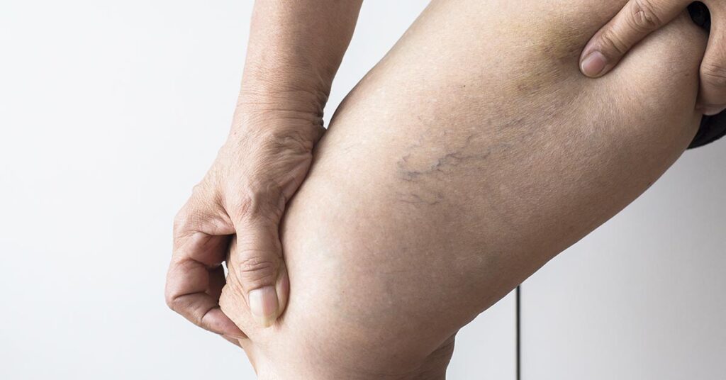 Varizes: como fica a perna após a cirurgia?
