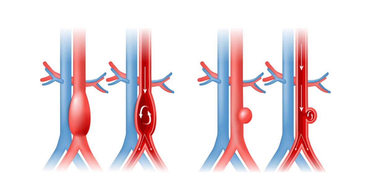 Operacao De Aneurisma De Aorta Abdominal Aneurisma Da Aorta Abdominal