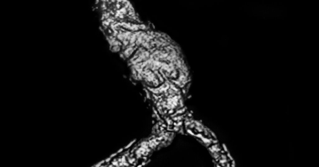 Segunda Opinião em Aneurisma Abdominal_ Quando Buscar